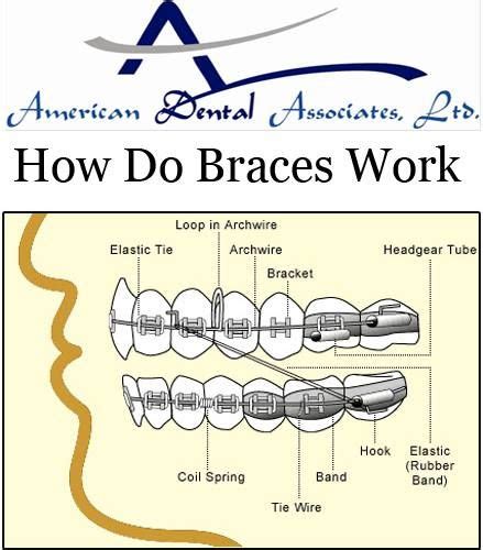 Know About How Do Braces Work Dental Best Dentist Dentist In