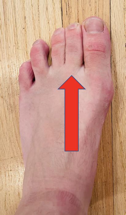Second Toe Pain Capsulitis Of The Second Toe Dr Justin Dean