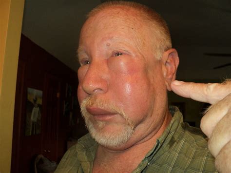 Wasp Sting Allergic Reaction