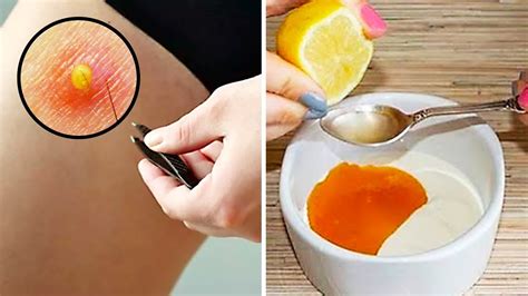 Dont Wait Until Your Ingrown Hair Turns Into A Cyst Remove It With This Easy Method Youtube