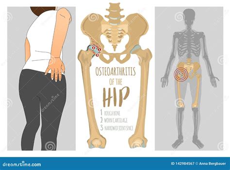 Hip Osteoarthritis Infographic Stock Vector Illustration Of Anatomy