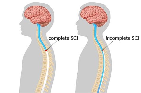 Lumbar Spinal Cord Injury What To Expect After L1 L2 L3 L4 L5 Sci