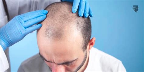 Signs Of Early Hair Loss And How To Stop It Ahs India