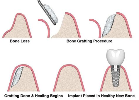 What Is Dental Bone Grafting And Why Do We Use It Gordon Dental