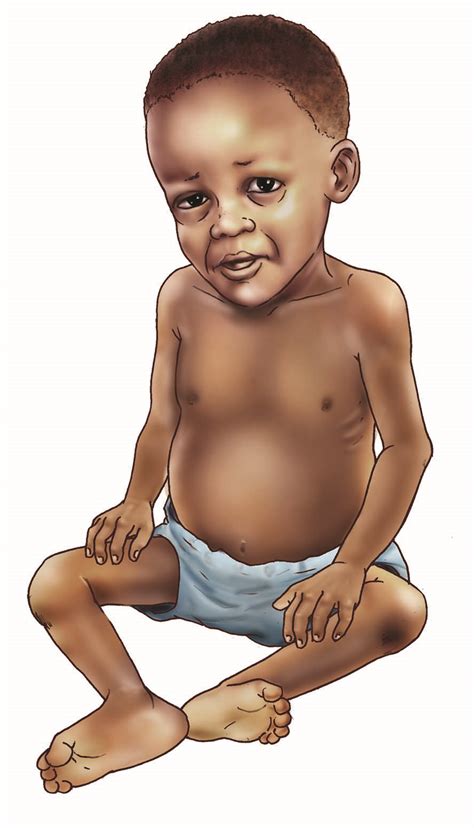 Sick Baby Health Care Malnourished Baby 6 24 Mo 00 Niger Iycf