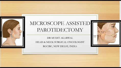 Microscope Assisted Modified Facelift Incision Parotidectomy Youtube