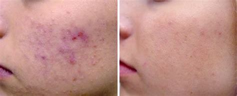 Acne And Acne Scar Revision Fotona