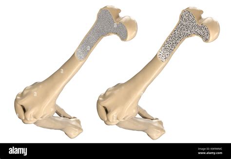 El Hueso Del Muslo Humano Normal Y Con Osteoporosis Ilustración 3d