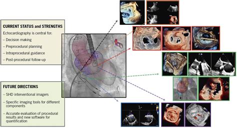 Echocardiographic Guidance In Transcatheter Structural Cardiac