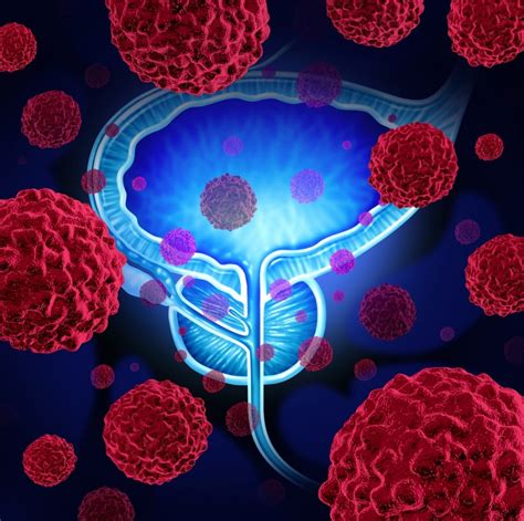 Cancer De Prostata Cauze Simptome Tipuri Diagnostic Tratament