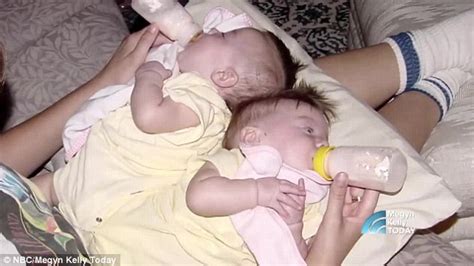 Conjoined Twin Sisters Thriving 17 Years Later But Insist They Can Still Feel Each Other S