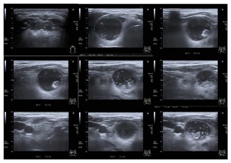 Thyroid Ultrasound Carreras Medical Center