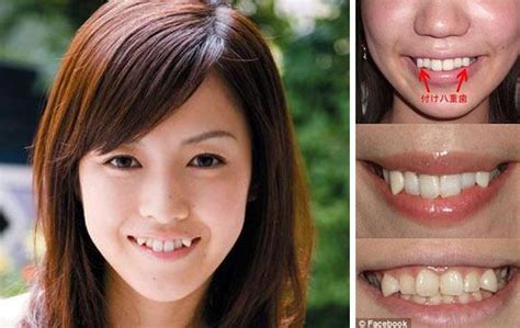 Yaeba Teeth Before And After