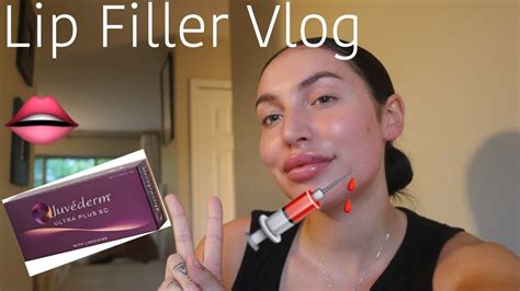 Lip Filler Vlog Juvéderm Ultra Plus Xc Before During And After