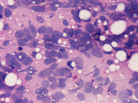Small Cell Carcinoma In The Mammary Gland Primary Or Metastatic A