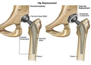 Best Hip Replacement Surgeon In Delhi Hip Replacement Surgery