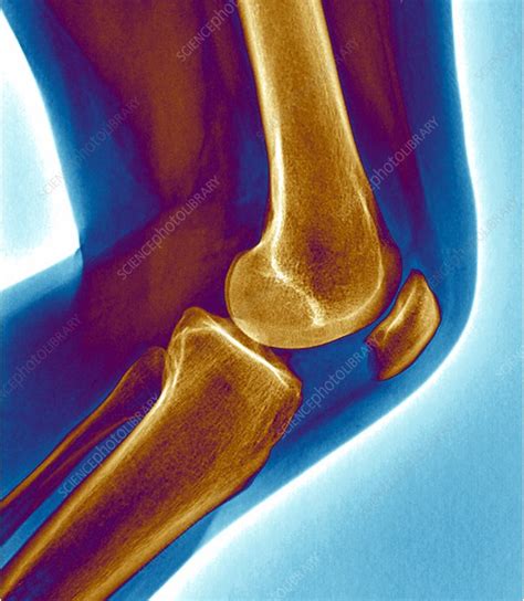 Healthy Knee Joint X Ray Stock Image C0096763 Science Photo Library
