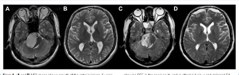 Figure 1 From Negative Pressure Hydrocephalus A Case Report On
