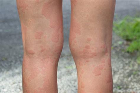 Questions To Ask Your Doctor About Chronic Hives