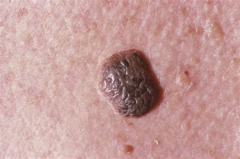Not Quite A Freckle Or Mole Are Your Brown Spots Seborrheic Keratoses