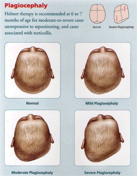 Positional Plagiocephaly Flat Head Syndrome Artofit