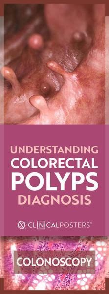 Should You Worry About Colorectal Polyps Colorectal Polyp Polyps Colon