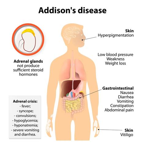 Addison S Disease How To Take Control Of The Condition