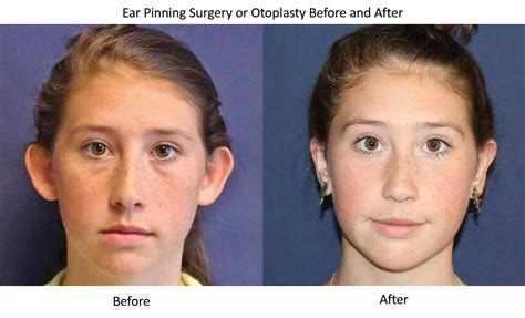 Otoplasty Seattle Ear Pinning Surgery Kirkland Dr Windle Dr Brian