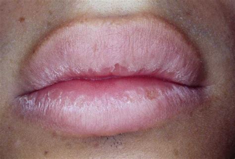 67 Hd Inflammation Vermilion Border Lip Insectpedia