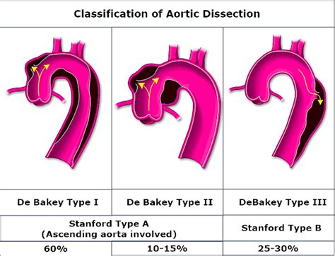 Aortic Dissection Medical Interventional And Surgical Management Heart