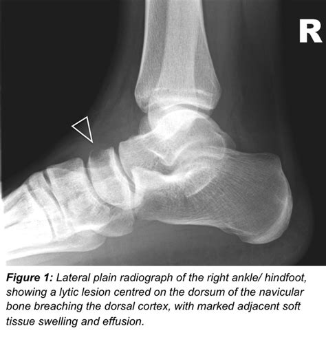 Lateral Plain Radiograph Of The Right Ankle Showing A Lytic Lesion