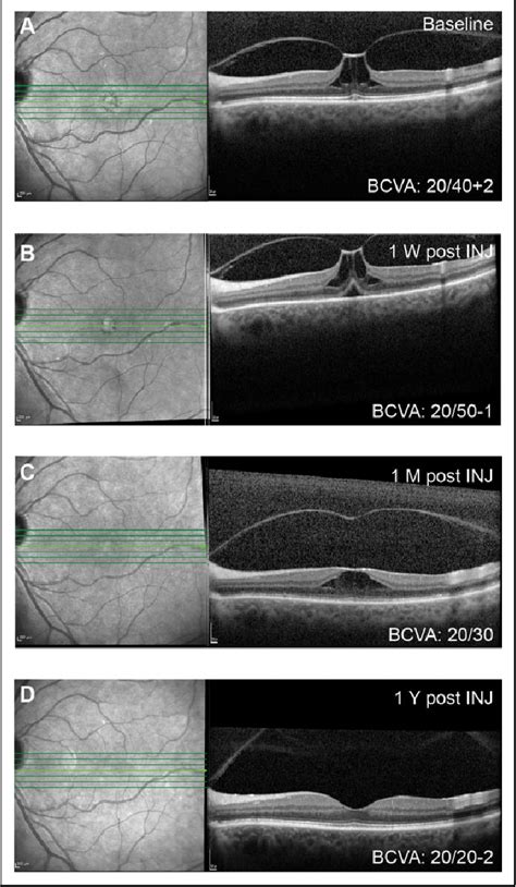 Figure 2 From Full Thickness Macular Hole And Symptomatic Vitreomacular