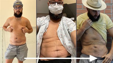 Male Liposuction And Chest Reduction Michael S Gynecomastia And Fat