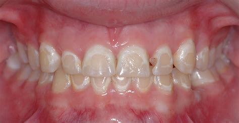 The Hyper White Areas Are Examples Of Tooth Decalcification Or