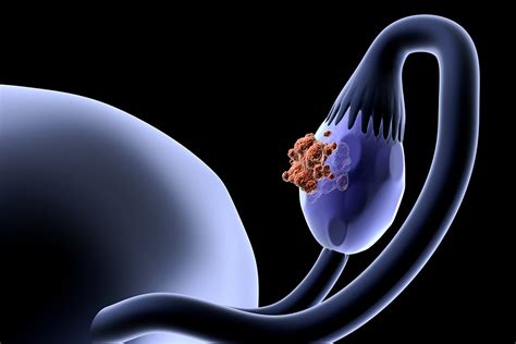 What Causes Ovarian Cancer New Study Suggests The Root May Be Found In