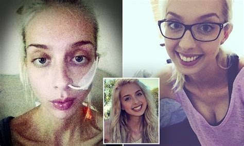 Victoria Woman Opens Up About Her Battle With Anorexia Daily Mail Online