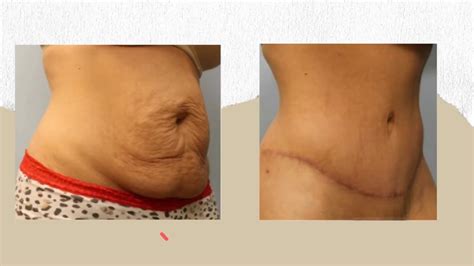 Abdominoplasty Before After Surgery Performed At Salem Plastic Surgery Youtube