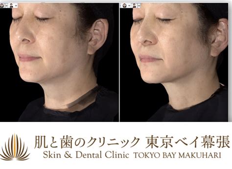 症例写真 カベリン 自然に脂肪が減り、お顔全体が引き締まった印象 肌と歯のクリニック 東京ベイ幕張 千葉 美容皮膚科