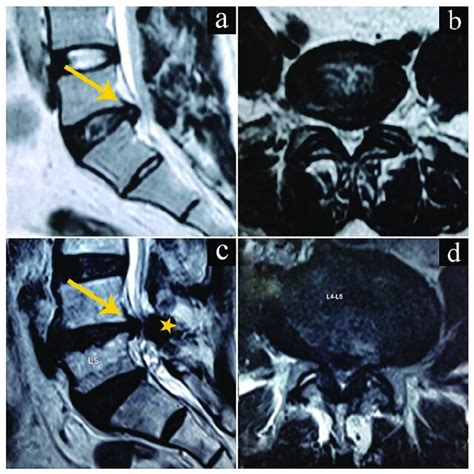 Mri Images Showing Intervertebral Disc Herniations A Sagittal View