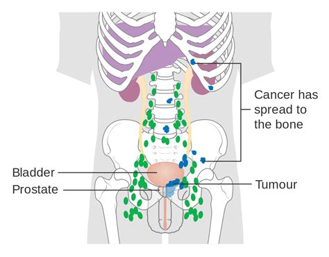 Cancer that has spread is more likely to generate more complications than when it is still at its early stage. File:Diagram showing prostate cancer that has spread to ...