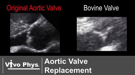 Pre Post Aortic Valve Replacement Surgery With A Bovine Valve Youtube