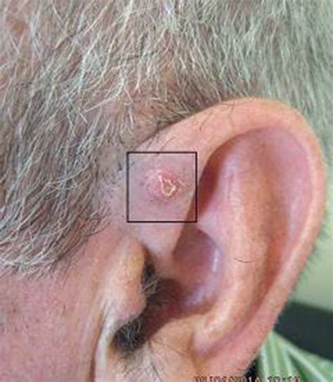 Squamous Cell Carcinoma Ear