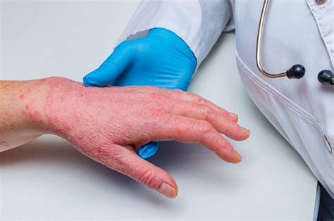 Laser Treatment For Patients With Psoriasis Short Hills Dermatology