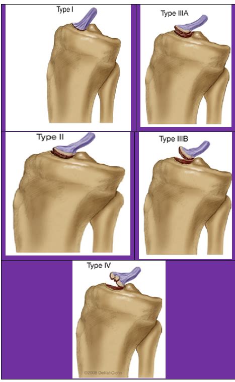 Tibial Spine Fracture And Physical Therapy Protocol Physiopedia