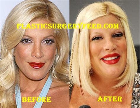 Tori Spelling Before And After Plastic Surgery Plastic Surgery Feed
