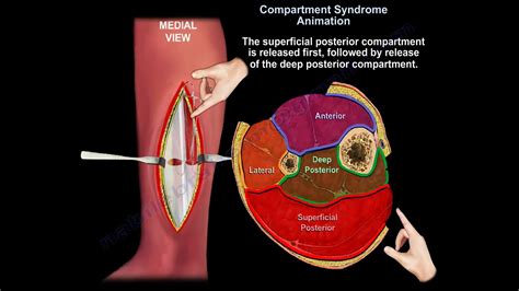 Acute And Chronic Leg Compartment Syndrome Everything You Need To