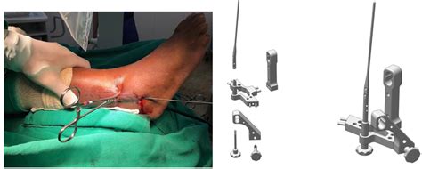 Osteosynthesis Of Ankle Fractures With An Intramedullary