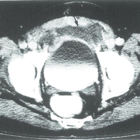 Pdf The Stoppa Procedure In Inguinal Hernia Repair To Drain Or Not To Drain