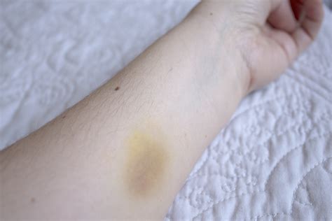 How To Get Rid Of A Hematoma Healthfully