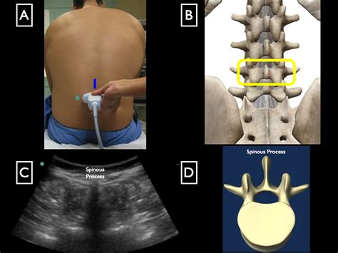 Lumbar Puncture — Highland Em Ultrasound Fueled Pain Management